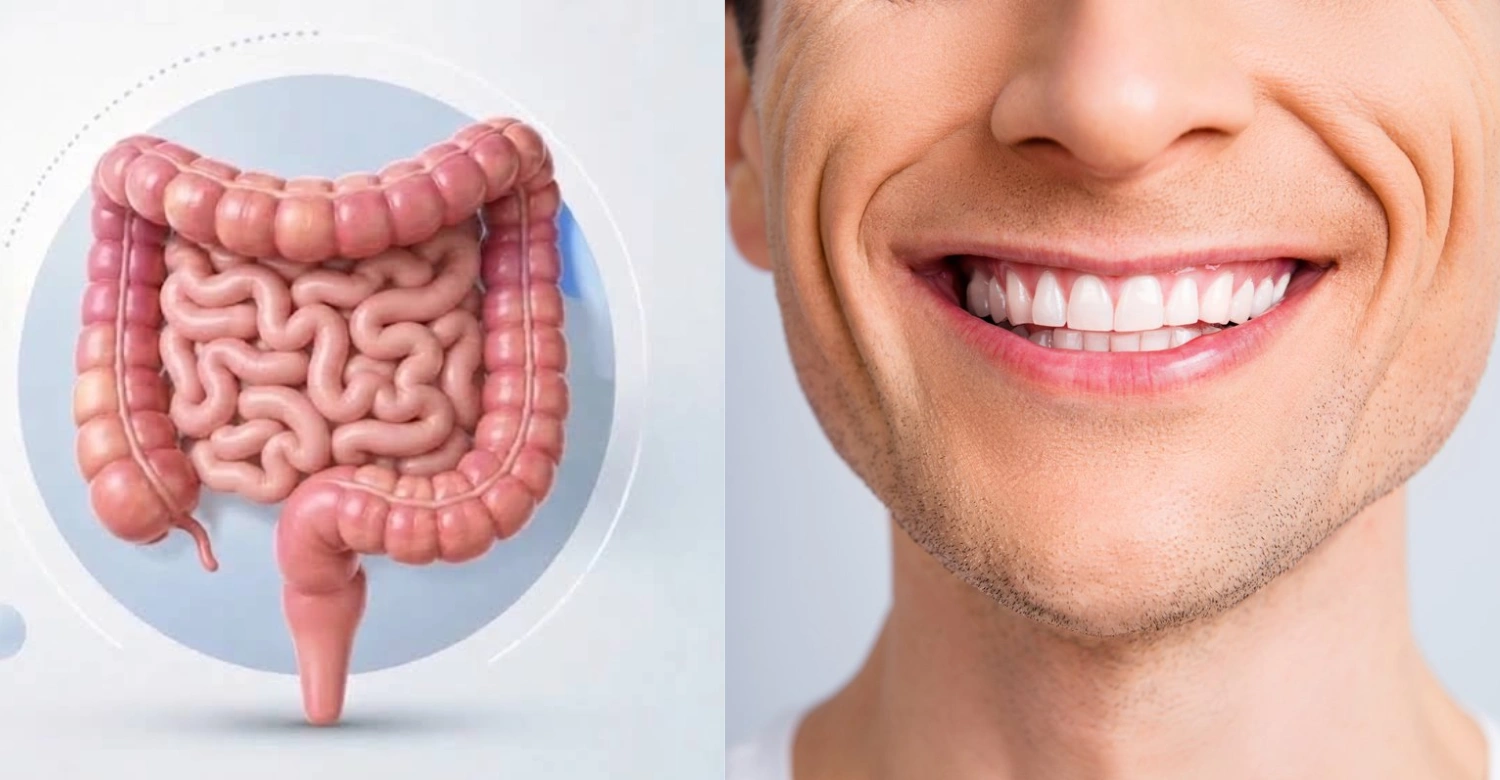 IBD and Oral Health 2